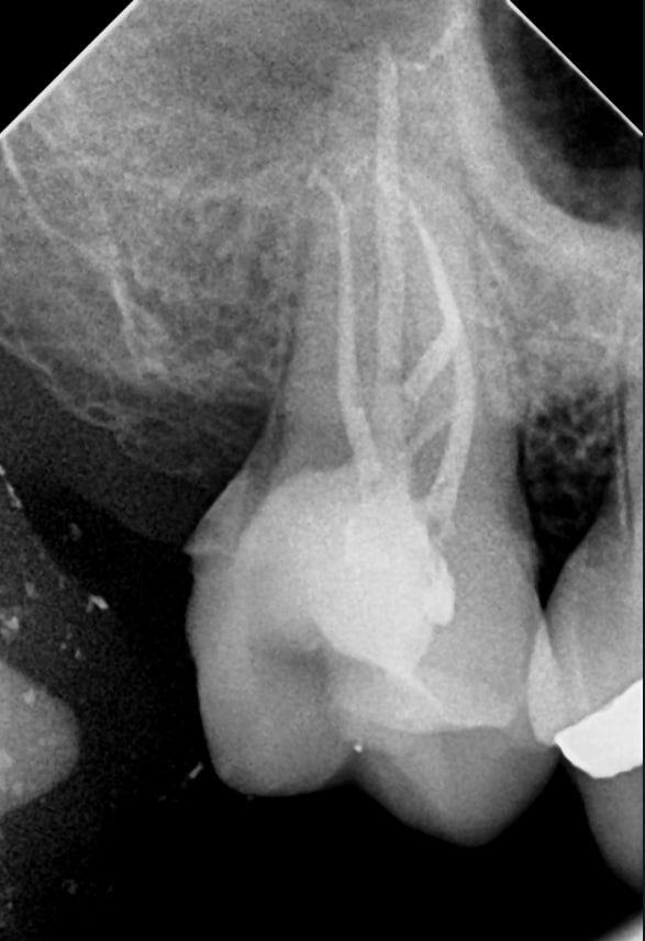 Radiografía final - molar con 5 conductos obturados