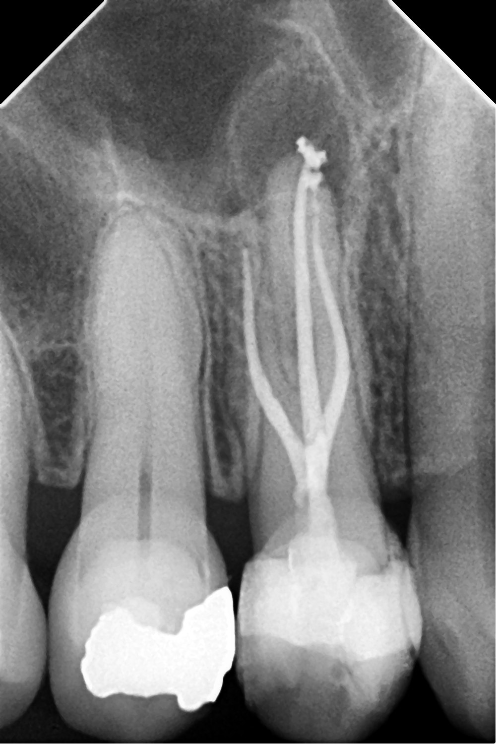 Radiografía final - premolar con 3 conductos obturados
