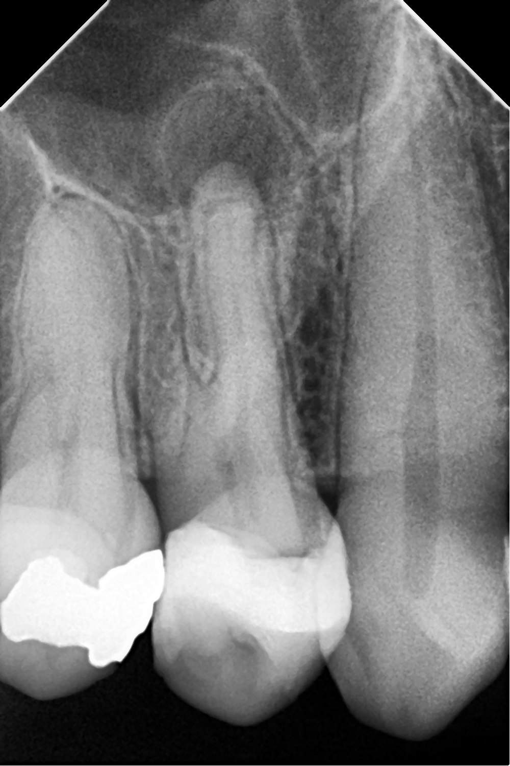 Radiografía inicial - premolar superior con 3 conductos
