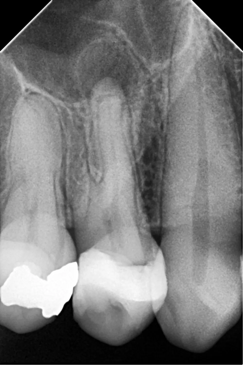 Radiografía inicial - premolar superior con 3 conductos