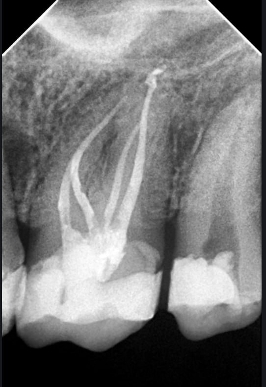 Radiografía periapical de un conducto obturado, documentación de un caso clínico