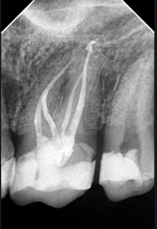 Radiografía periapical de un conducto obturado, documentación de un caso clínico