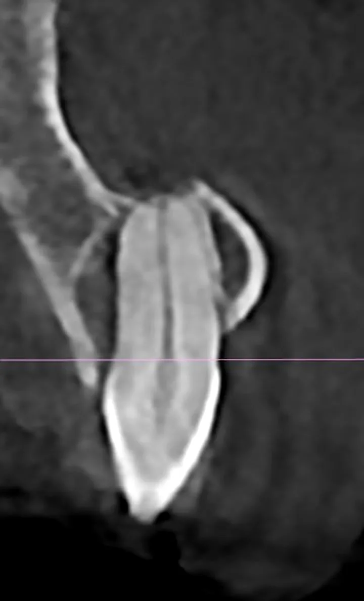 Corte tomográfico de un traumatismo dental real